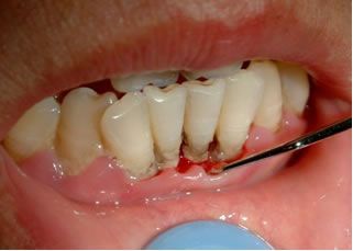 牙结石脱落后的影响